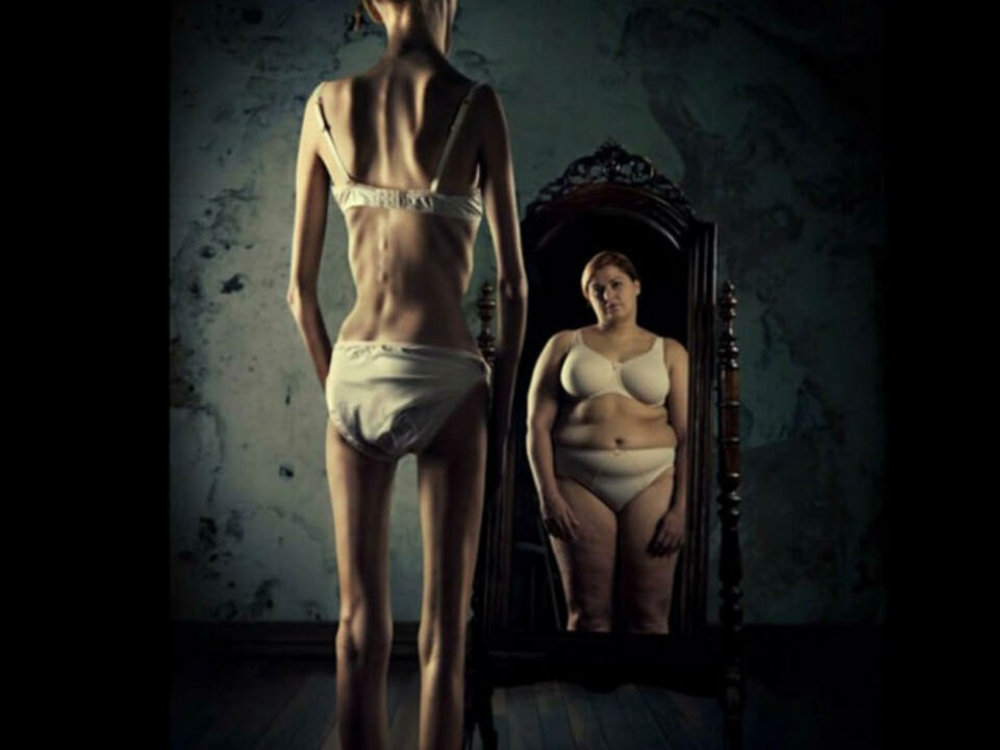 Anorexia, transtorno alimentar que pode levar à morte se não optar por tratamento